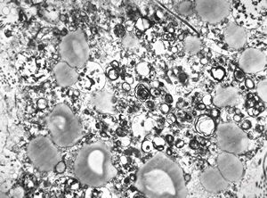 F,68y. | xanthomatous cell in atherosclerotic plaque - a. vertebralis F,68y. | xanthomatous cell in atherosclerotic plaque - a. vertebralis